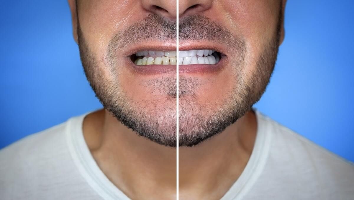 How To Whiten Yellow Teeth